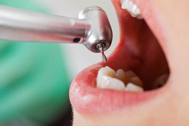 Best Emergency Dental Care for Abscessed Tooth in Richmond, TX